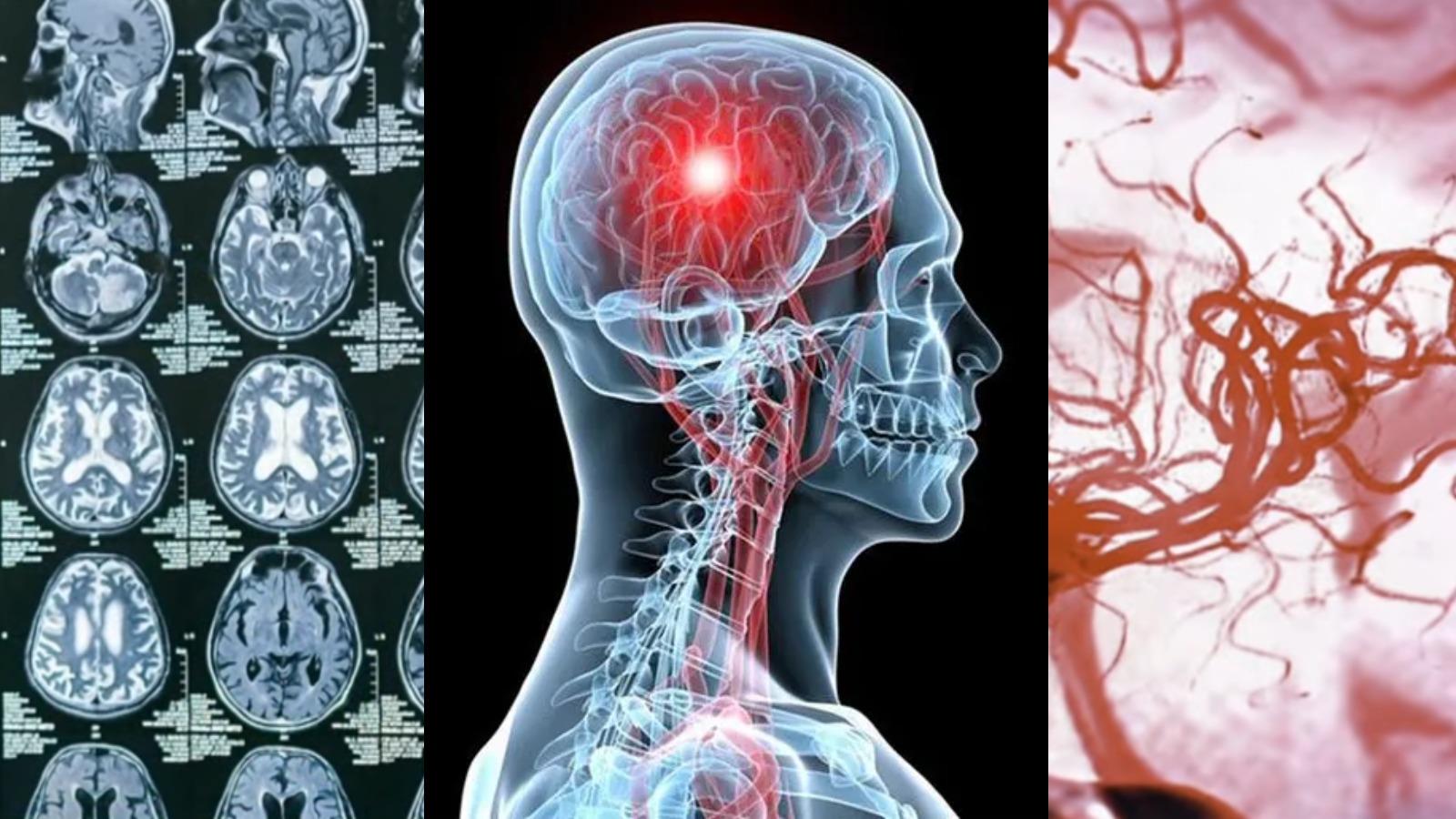 بعد الإصابة بالجلطة الدماغية .. هل من الممكن أن تتكرر؟