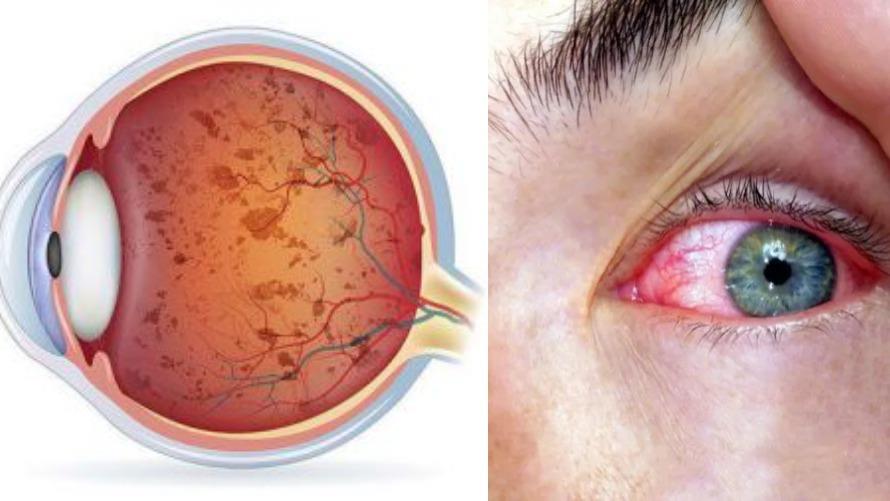 التهاب الشبكية الصباغي .. حين يتحول ضعف النظر ليلا إلى خطر يهدد البصر