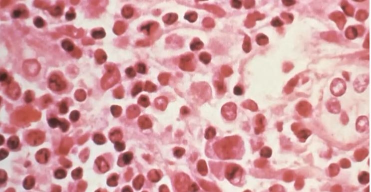 Hantavirus : le Brésil signale son premier décès, "un cas isolé" sans lien avec le navire MV Hondius