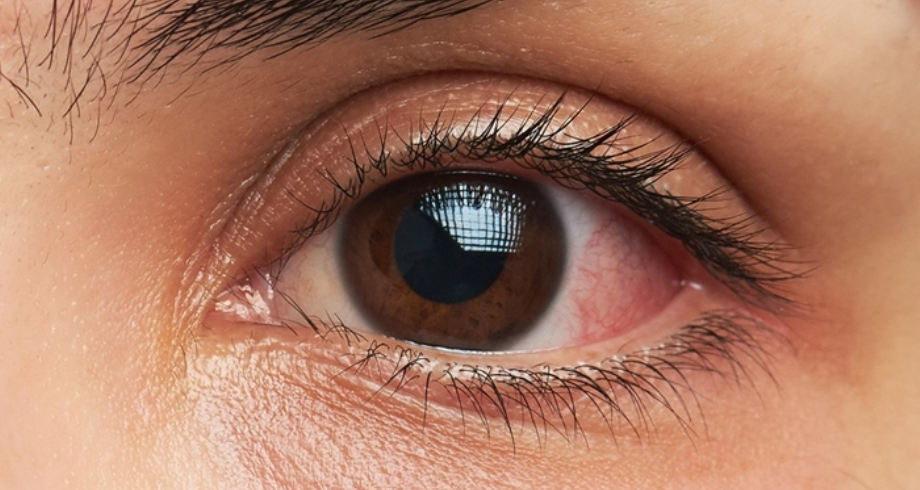 نتائج مشجعة لعلاج جديد لأكثر أشكال سرطان العين شيوعاً